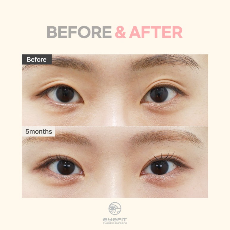 [Double Eyelid Dissolving] Why Does It Happen? From Causes to Solutions! image 5