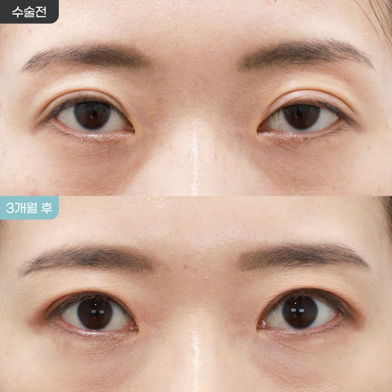높은 쌍꺼풀 라인 낮추기, 절개 눈매교정 재수술 3개월 전후 관련 이미지 1