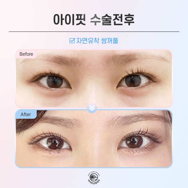 [Eyefit Plastic Surgery] Natural and lively with natural adhesion double eyelid surgery! image 3