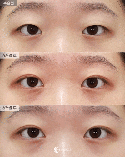 자연스러운 인라인 자연유착 + 앞트임 리얼 전후 [아이핏성형외과] 관련 이미지 2