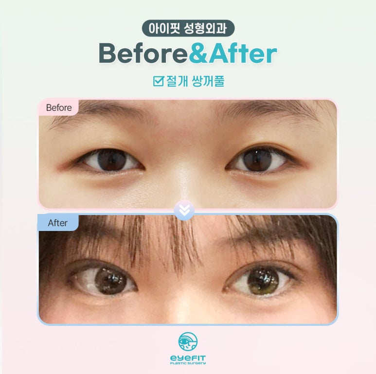 Have You Seen an Incision Double Eyelid This Natural? image 3