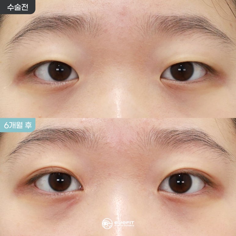 자연스러운 인라인 자연유착 + 앞트임 리얼 전후 [아이핏성형외과] 관련 이미지 1