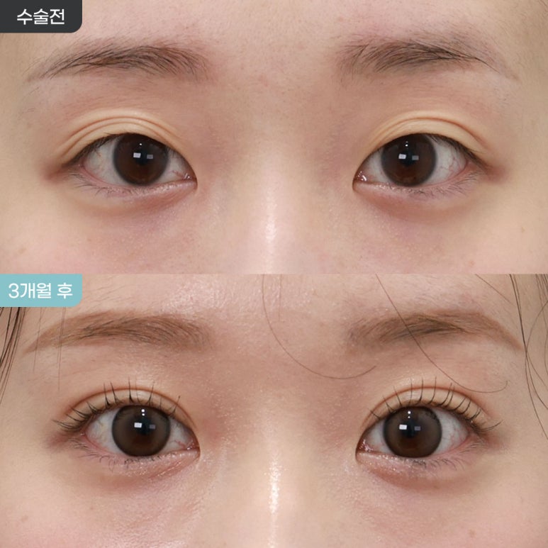 [아이핏성형외과]겹주름+짝눈 교정, 자연유착 3개월 전후✨ 관련 이미지 1