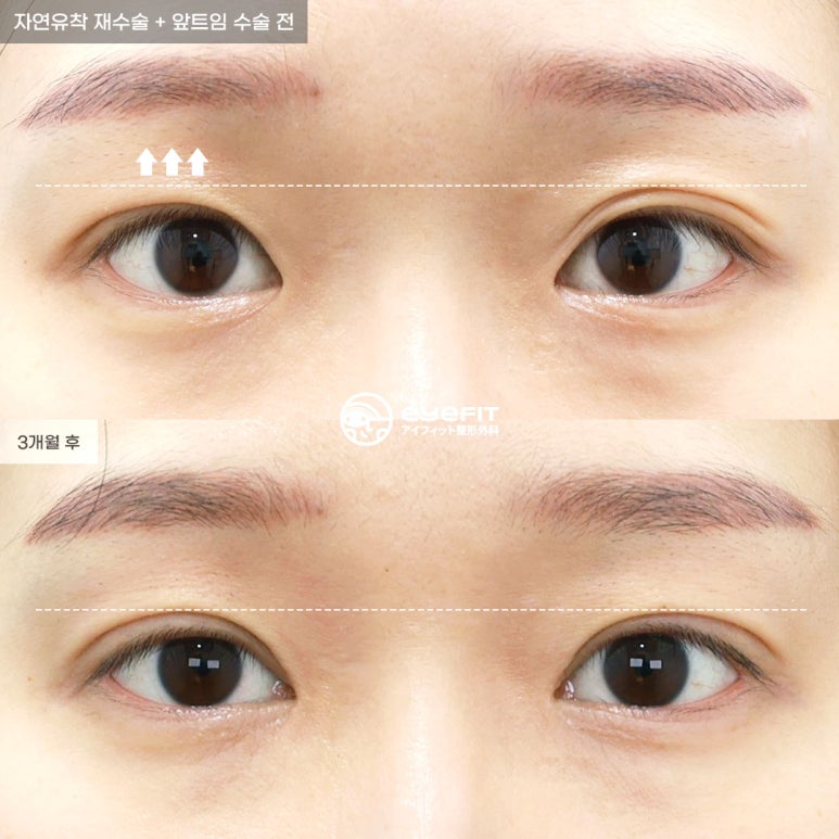 아이핏성형외과 | 자연유착&middot;절개 쌍꺼풀 재수술 케이스 관련 이미지 2