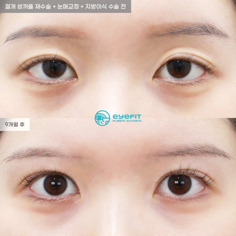 아이핏성형외과 | 자연유착&middot;절개 쌍꺼풀 재수술 케이스 관련 이미지 4
