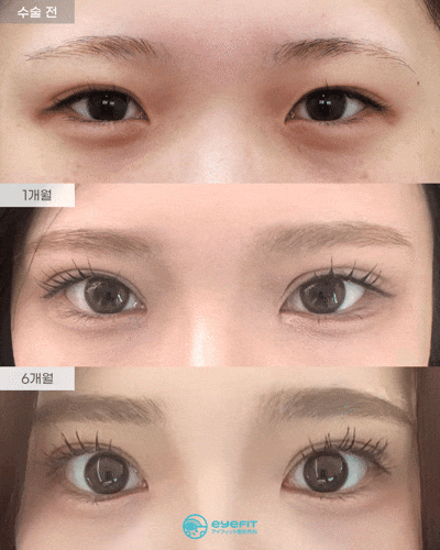 [Eyefit Plastic Surgery] Revision Surgery with Natural Adhesion, Before-and-After Epicanthoplasty Real Video🩵 image 1
