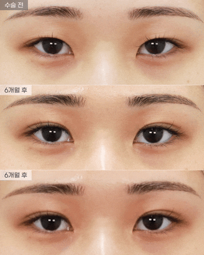 Natural Adhesion + Medial Epicanthoplasty: 6-Month Progress Before and After [Eyefit Plastic Surgery] image 2