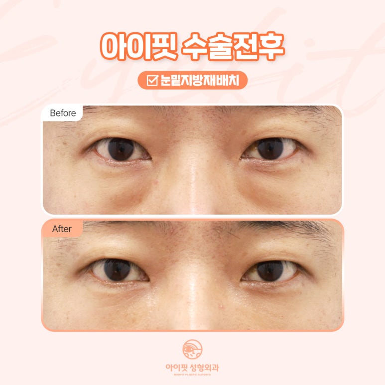 [아이핏 성형외과] 아이핏 눈밑지방재배치, 어떤 다를까? 관련 이미지 5