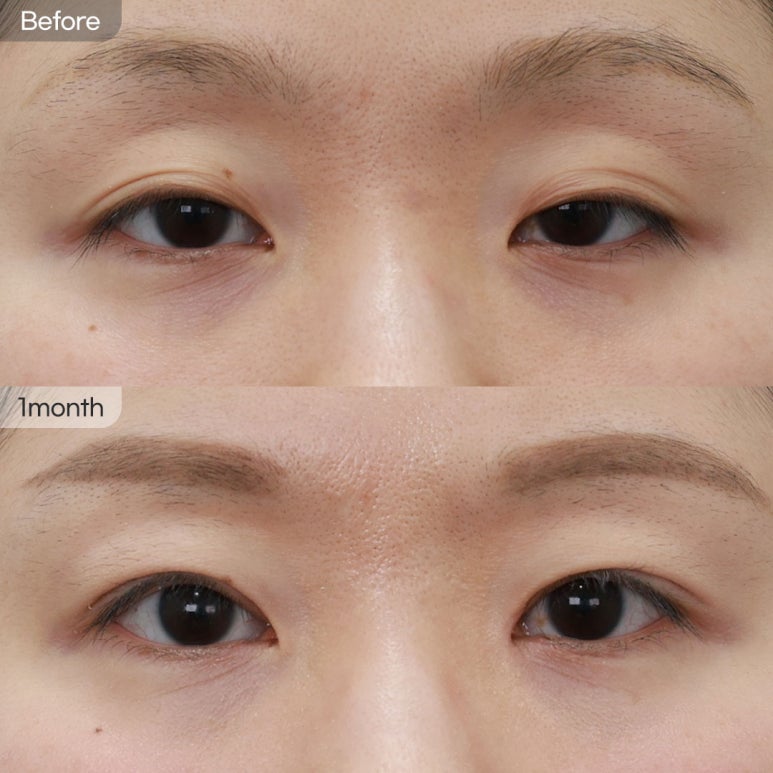 [Eyefit Plastic Surgery] Real Before-and-After Video of Double Crease + Hollow Eyes Correction image 1