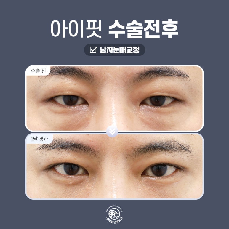[아이핏 성형외과] 남자눈매교정으로 또렷하고 선명하게 관련 이미지 4