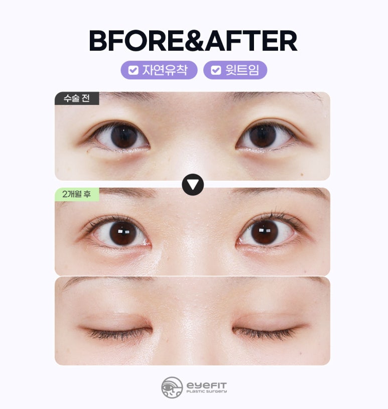 아이핏성형외과 | 자연유착&middot;절개 쌍꺼풀 재수술 케이스 관련 이미지 3