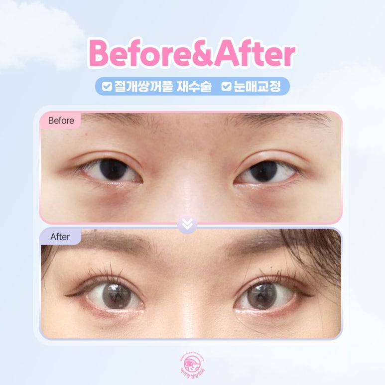 아이핏성형외과 | 자연유착&middot;절개 쌍꺼풀 재수술 케이스 관련 이미지 6