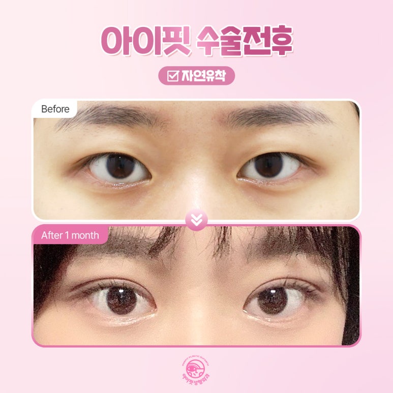 Why Is EyeFit Natural Adhesion Double Eyelid Surgery So Popular? image 5