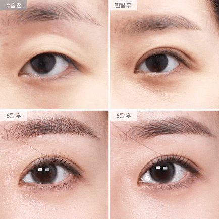[I-Fit Plastic Surgery] Natural Adhesion Q&A (ft. Recommended Types for Natural Adhesion) image 3