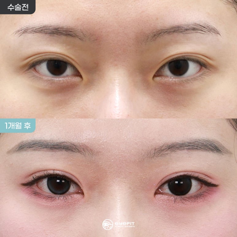 겹주름 개선, 자연유착 1개월 전후 [아이핏성형외과] 관련 이미지 1