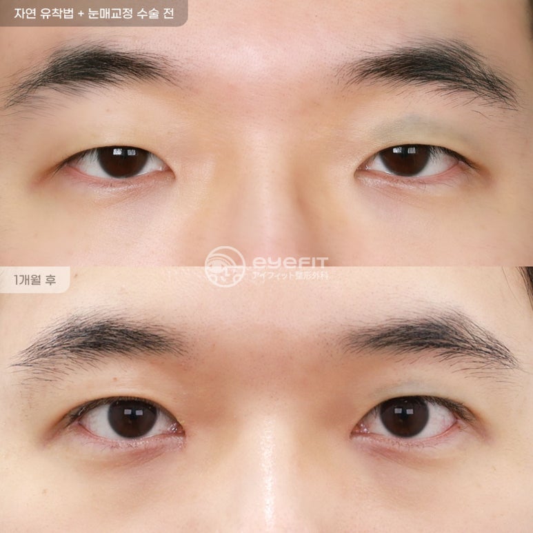 [Eyefit Plastic Surgery] When the eyes lack the strength to open, make them clearer with eye correction image 4