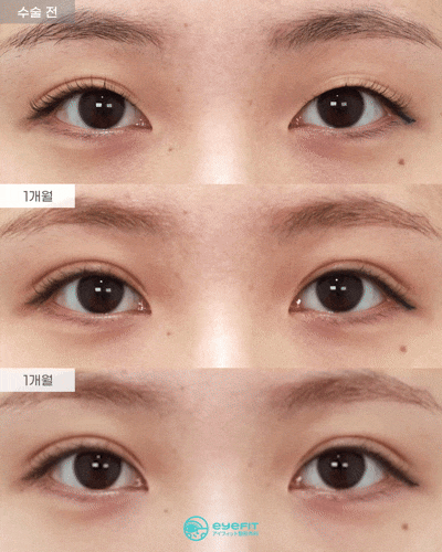[아이핏성형외과]짝눈 자연유착 리얼영상🩵 관련 이미지 1