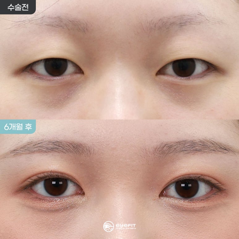 Natural Adhesion: Before and 6 Months After [Eyefit Plastic Surgery] image 1