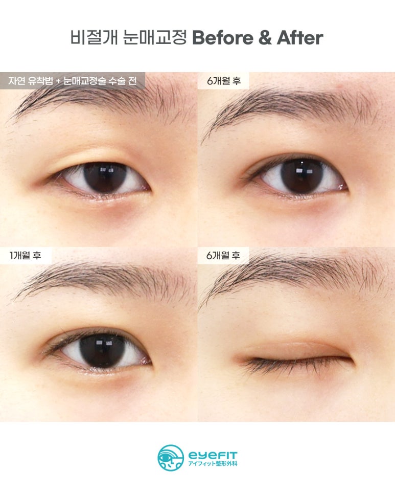 [Eyefit Plastic Surgery] When the eyes lack the strength to open, make them clearer with eye correction image 2