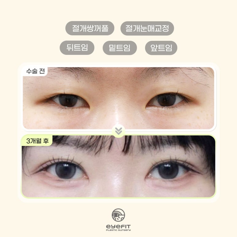아이핏성형외과 | 자연유착&middot;절개 쌍꺼풀 재수술 케이스 관련 이미지 5