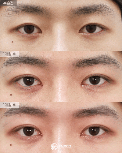 Male Double Eyelid Revision with Natural Adhesion + Medial Canthoplasty: 1-Month Before and After [Eyefit Plastic Surgery] image 2