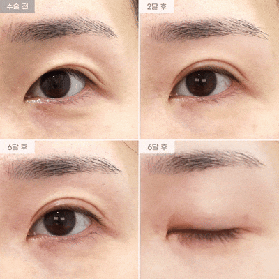 [Eyefit Plastic Surgery] Revision Double Eyelid Incision Surgery, Revision Upper Epicanthoplasty — Real Video image 1