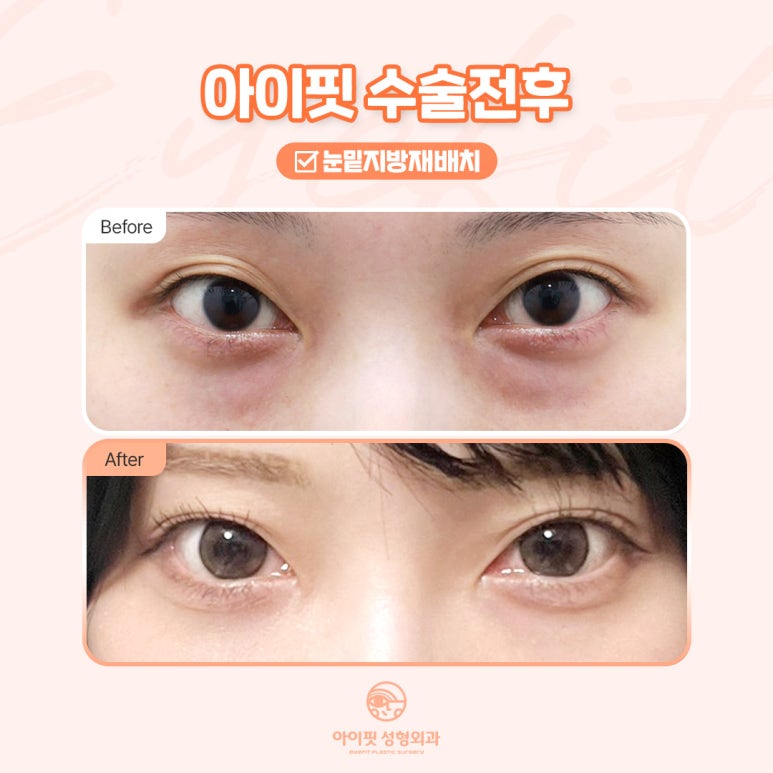 [아이핏 성형외과] 아이핏 눈밑지방재배치, 어떤 다를까? 관련 이미지 6