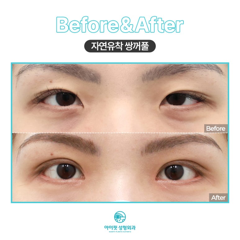 아이핏성형외과 자연유착 관련 이미지 2