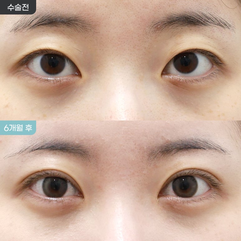 [Eyefit Plastic Surgery] Natural Adhesion + Upper Eye Corner Revision Before-and-After Real Video🩵 image 1