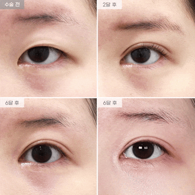 [Eyefit Plastic Surgery] Revision Surgery for Loose Double Eyelids (Revision Incisional Double Eyelid Surgery, Revision Epicanthoplasty) Real Video image 1