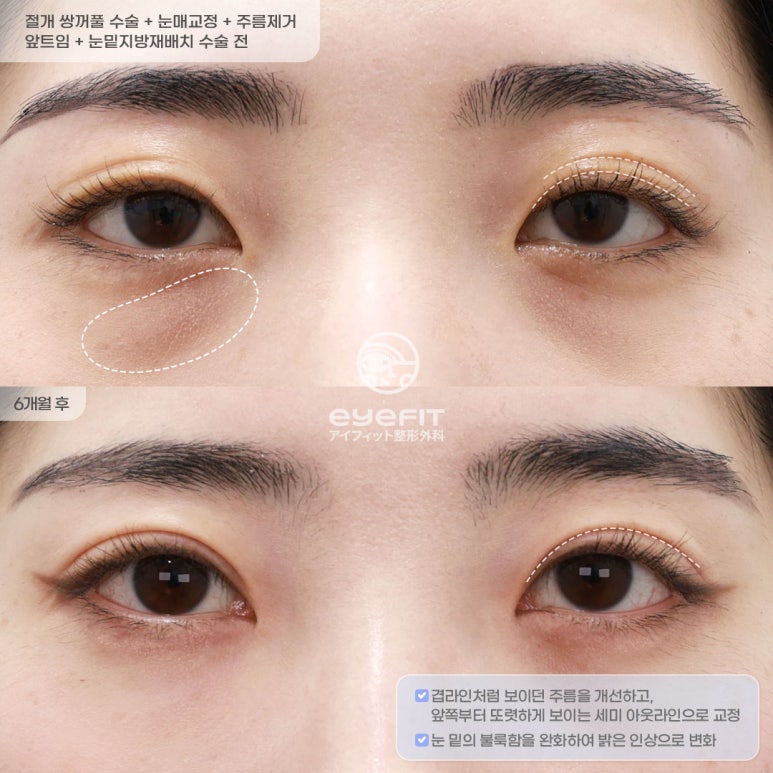 아이핏성형외과 | 자연유착&middot;절개 쌍꺼풀 재수술 케이스 관련 이미지 8