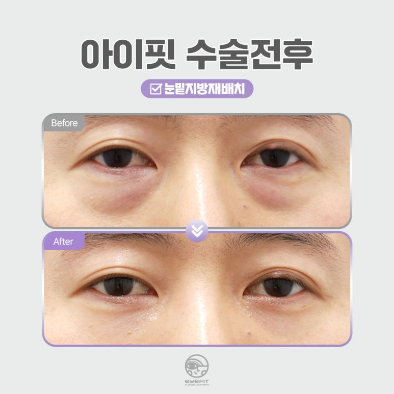 [Eyefit Plastic Surgery] Curious About the Difference Between Lower Eyelid Fat Repositioning and Lower Blepharoplasty? image 5