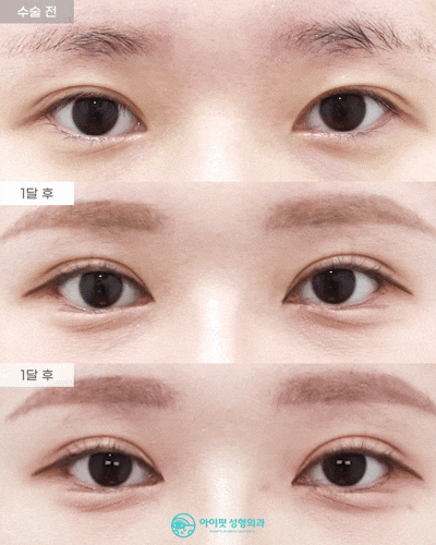 [Eyefit Plastic Surgery] Revision Surgery for Asymmetric Double Eyelids, Real Video of Lateral and Lower Epicanthoplasty image 1