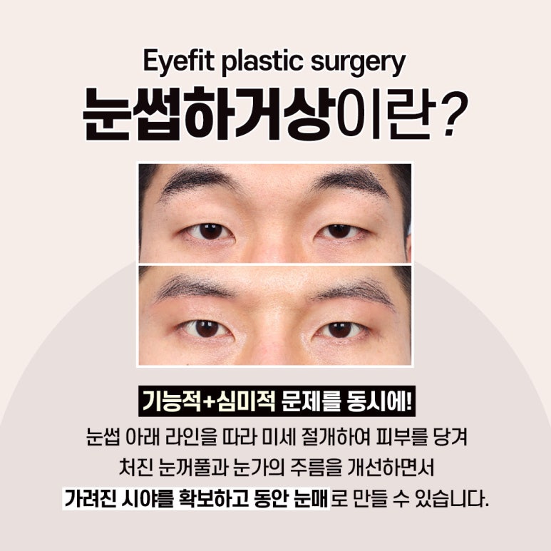 쳐진 눈을 또렷하게, 눈썹하거상술 관련 이미지 2