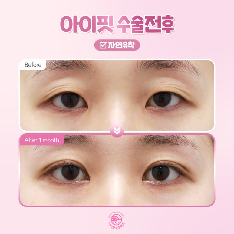 Why Is EyeFit Natural Adhesion Double Eyelid Surgery So Popular? image 4