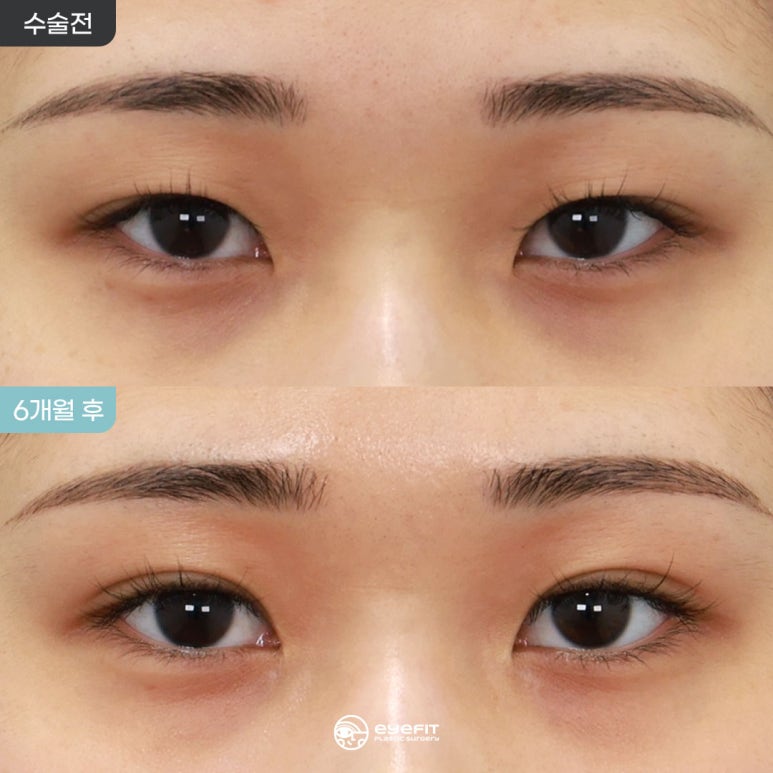 Natural Adhesion + Medial Epicanthoplasty: 6-Month Progress Before and After [Eyefit Plastic Surgery] image 1