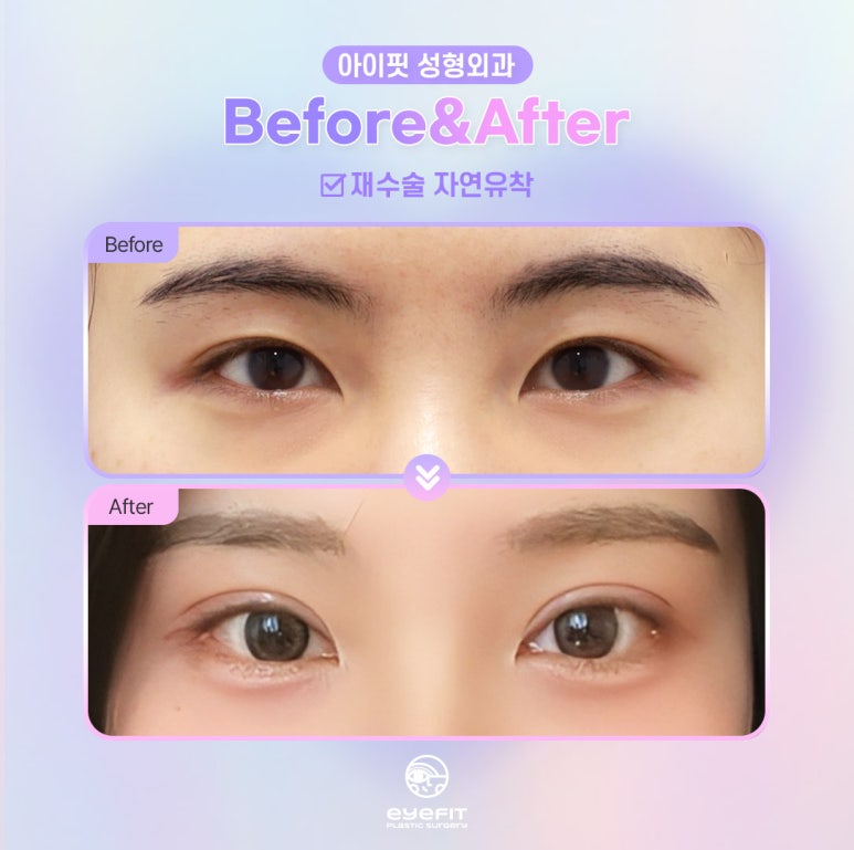 A Great Place for Revision Eye Surgery, Eyefit Plastic Surgery! image 4