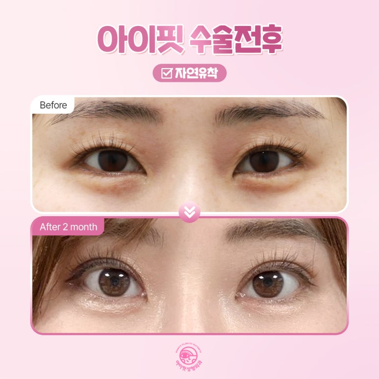 Why Is EyeFit Natural Adhesion Double Eyelid Surgery So Popular? image 6