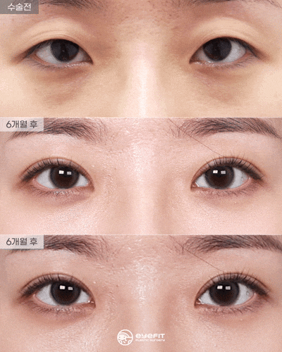 Natural-Adhesion Double Eyelid Surgery + Lower-Eyelid Fat Repositioning: Before and 6 Months After [Eye Fit Plastic Surgery] image 2