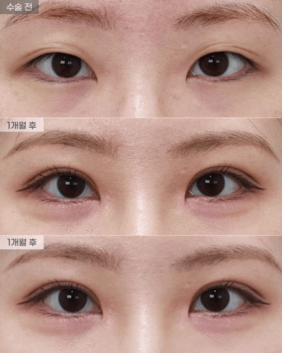 [Eyefit Plastic Surgery] Real Before-and-After Video of Natural Adhesion 🩵 image 1