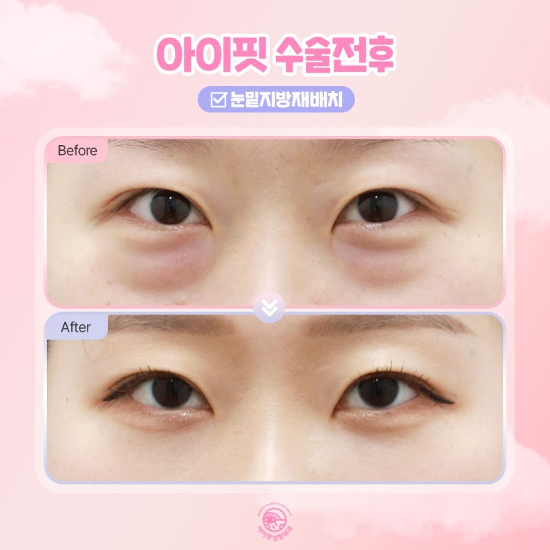 The Symbol of Youth Is Bright Under-Eyes! Eyefit Under-Eye Fat Repositioning image 4