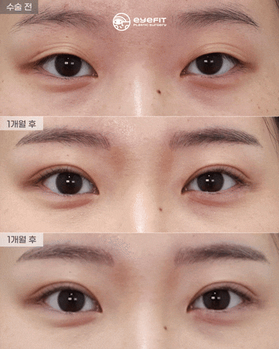 [Eyefit Plastic Surgery] Natural Adhesion Real Video 🩵 image 1