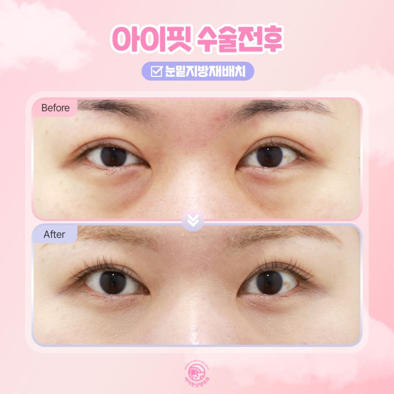 The Symbol of Youth Is Bright Under-Eyes! Eyefit Under-Eye Fat Repositioning image 3