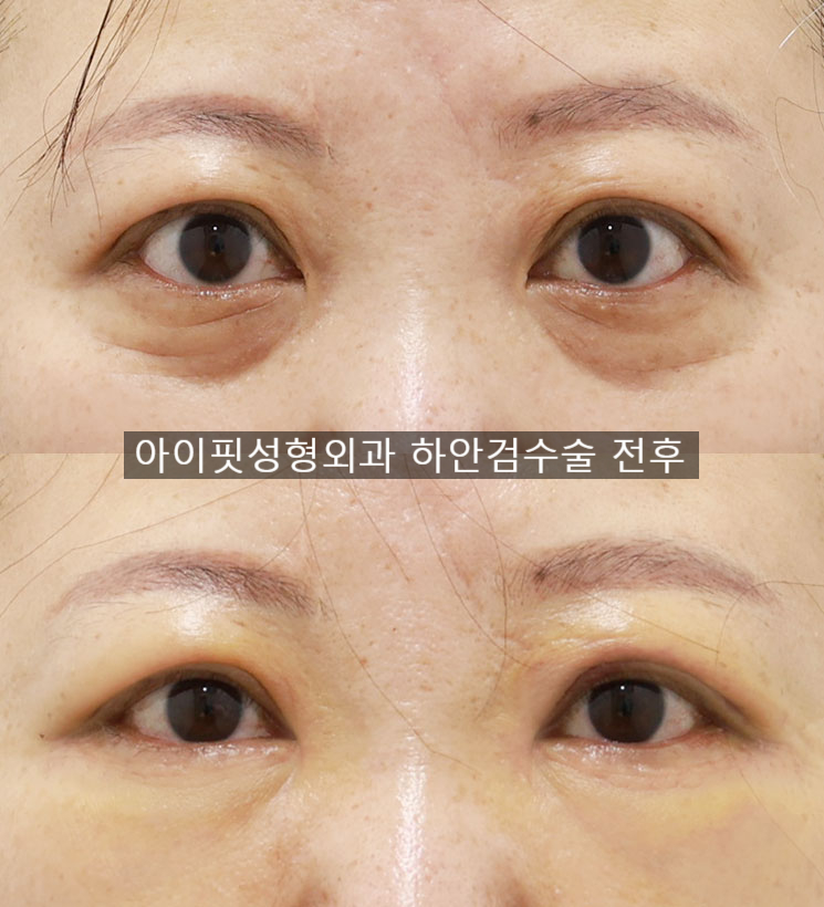 The Jewel of Midlife Eye Surgery: Lower Blepharoplasty image 5