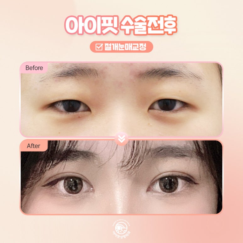 [아이핏성형외과] 절개눈매교정 전후 또렷한 눈매로 관련 이미지 4