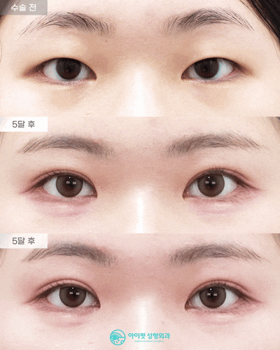 [Eyefit Plastic Surgery] Natural-looking incisional double eyelid even with eyes closed, real video image 1