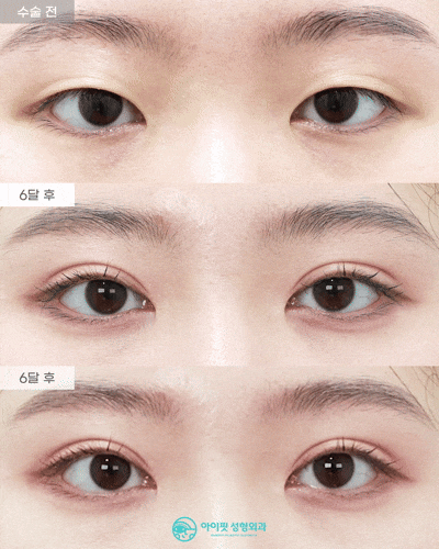 [EYEFIT Plastic Surgery] Natural Adhesion, Epicanthoplasty Real Video🩵 image 1
