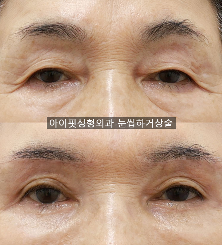 쳐진 눈을 또렷하게, 눈썹하거상술 관련 이미지 3