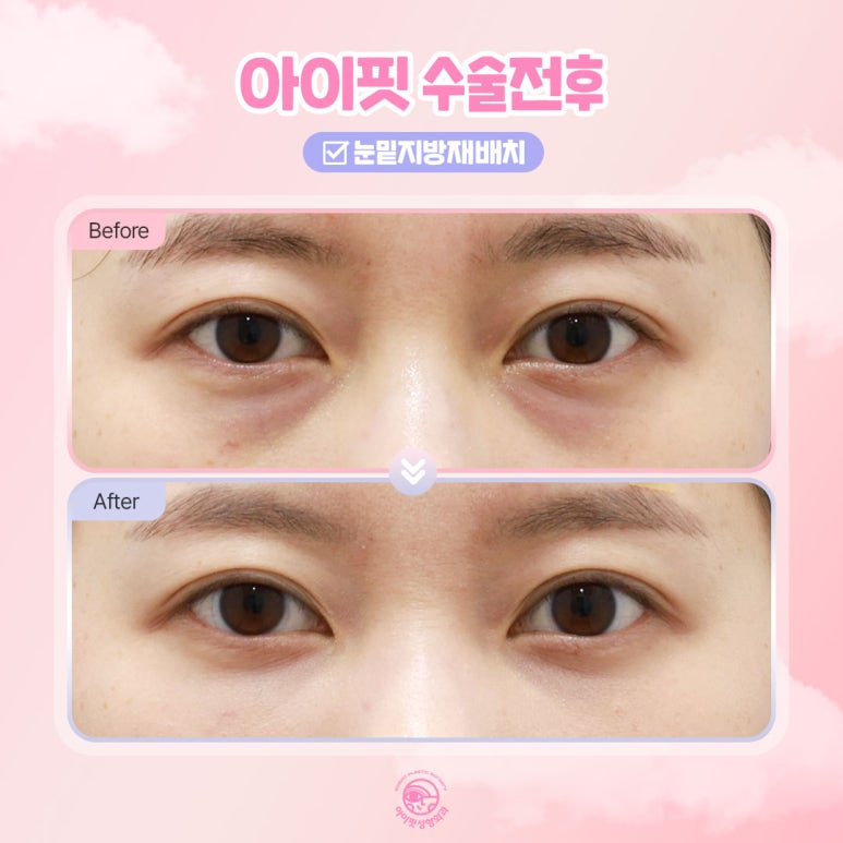The Symbol of Youth Is Bright Under-Eyes! Eyefit Under-Eye Fat Repositioning image 2