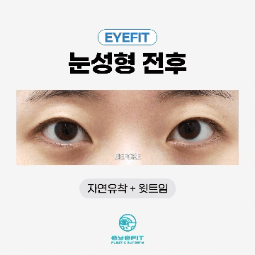 [I-Fit Plastic Surgery] Natural Adhesion Q&A (ft. Recommended Types for Natural Adhesion) image 6